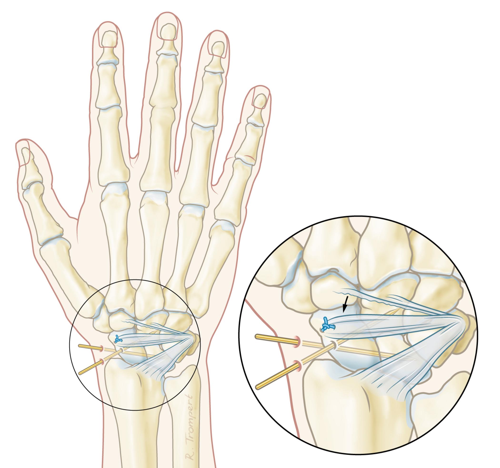 Scafo lunaire Dissociatie Orthoclinic Orthopedie Brugge scafo-lunaire-dissociatie-orthoclinic-orthopedie-brugge